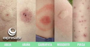 PICADURA INSECTO